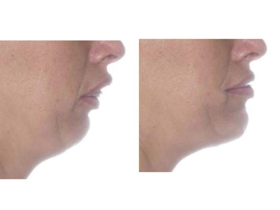 maxilofacial_quironsalud_campodegibraltar_cirugía