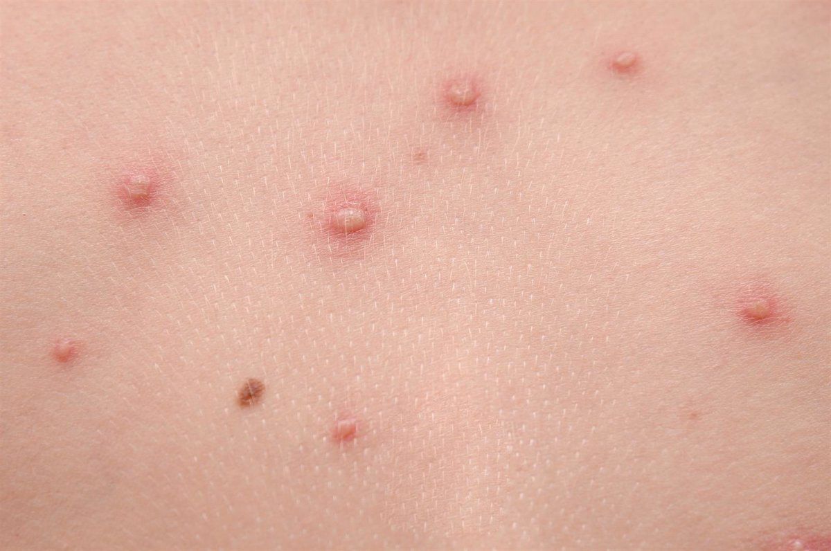 Sanidad notifica cuatro nuevos casos de viruela del mono, todos de la antigua variante. Foto: Europa Press. 